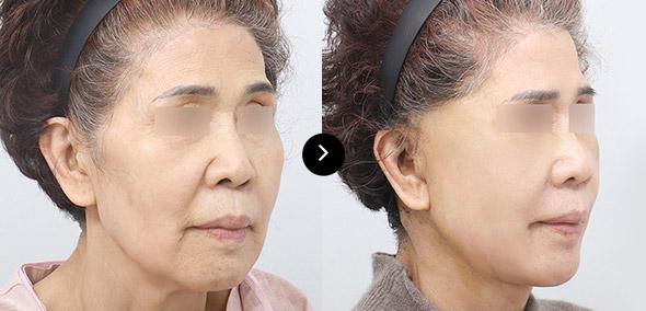 Căng da cắt rạch toàn phần image 1