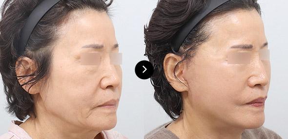 Căng da cắt rạch toàn phần image 2