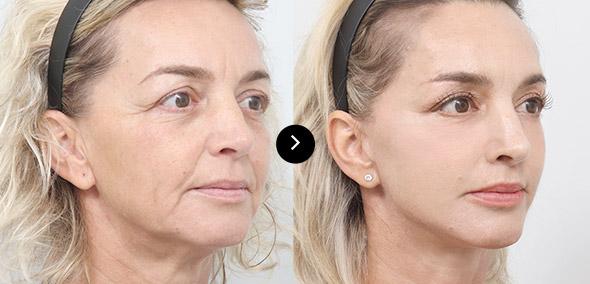 Căng da cắt rạch toàn phần image 3