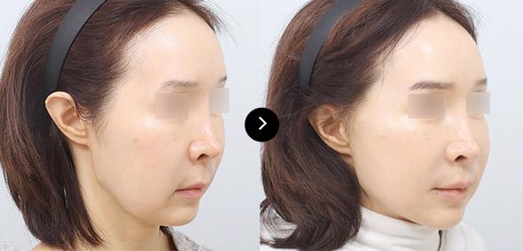 Căng da cắt rạch toàn phần image 5