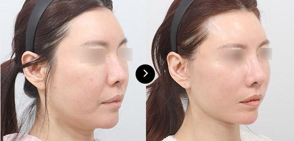 Căng da cắt rạch semi image 1