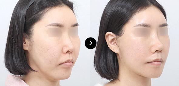 Căng da cắt rạch semi image 2