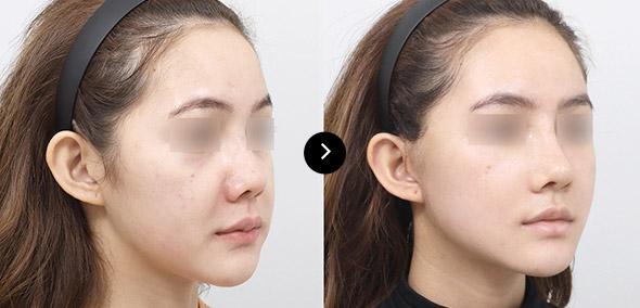 Căng da cắt rạch semi image 3