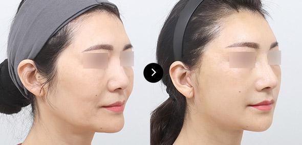 Căng da cắt rạch semi image 4