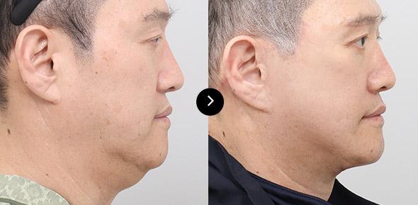 Căng da cổ image 1