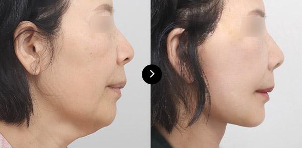 Căng da cổ image 2