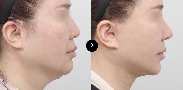 Căng da cổ image 3