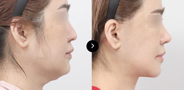 Căng da cổ image 4