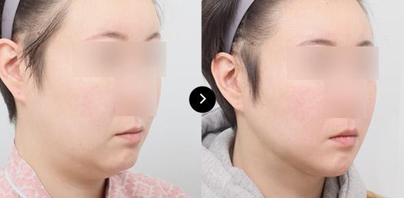 Căng da vùng nọng cằm image 2