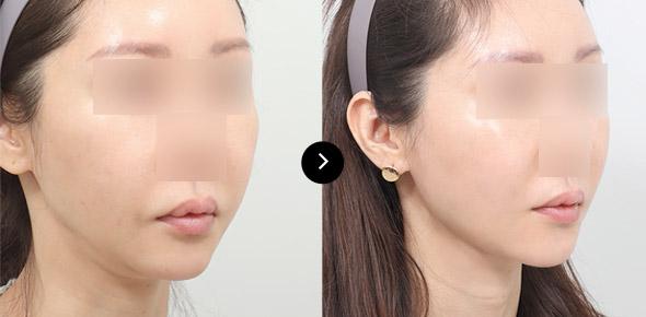 Căng da vùng nọng cằm image 4