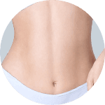 Liposuction result 3