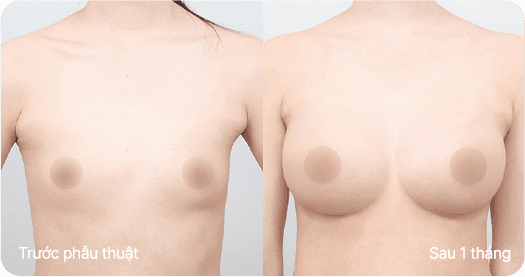 Ab Surgery