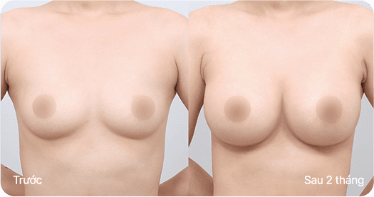 Ab Surgery
