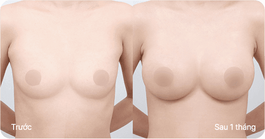 Ab Surgery
