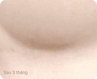 Ab Surgery
