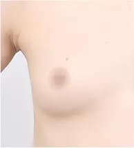 Trước phẫu thuật