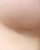 Đường cắt ở chân ngực sau 2 tháng