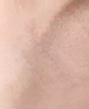 Đường cắt ở nách sau 1 tháng