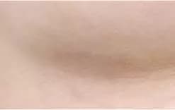 Sau phẫu thuật 3 tháng