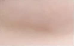 Sau phẫu thuật 10 tháng