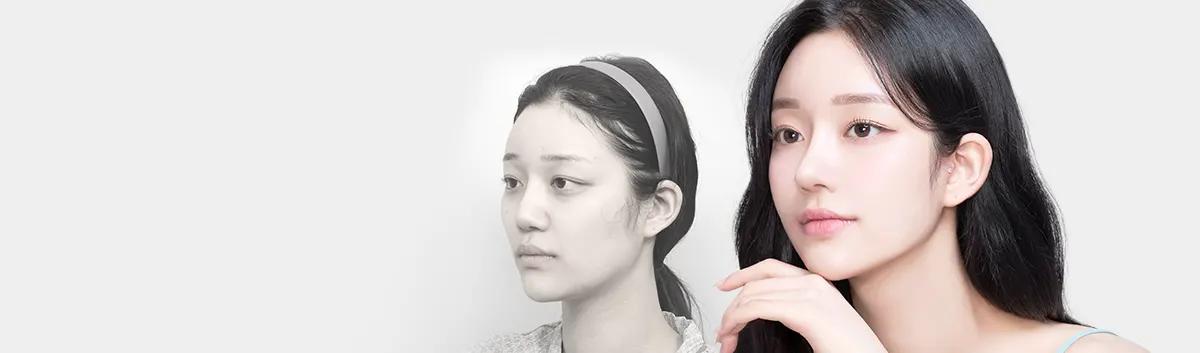Ảnh trước & sau AB