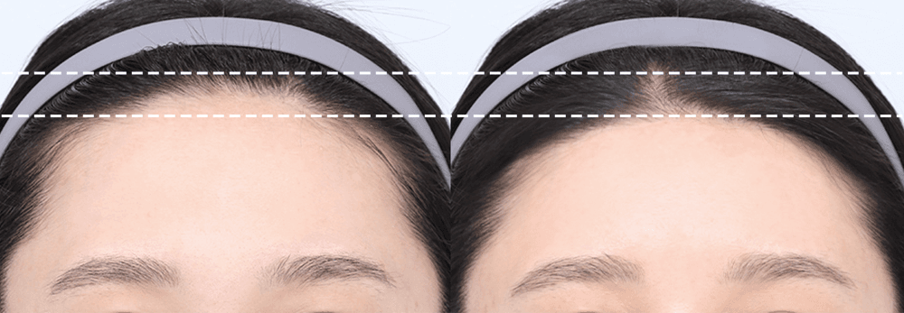 Hiệu quả rõ ràng bằng cách di chuyển da đầu