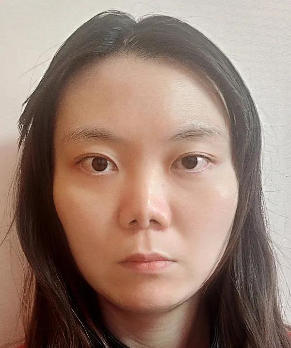 Before and after surgery front view