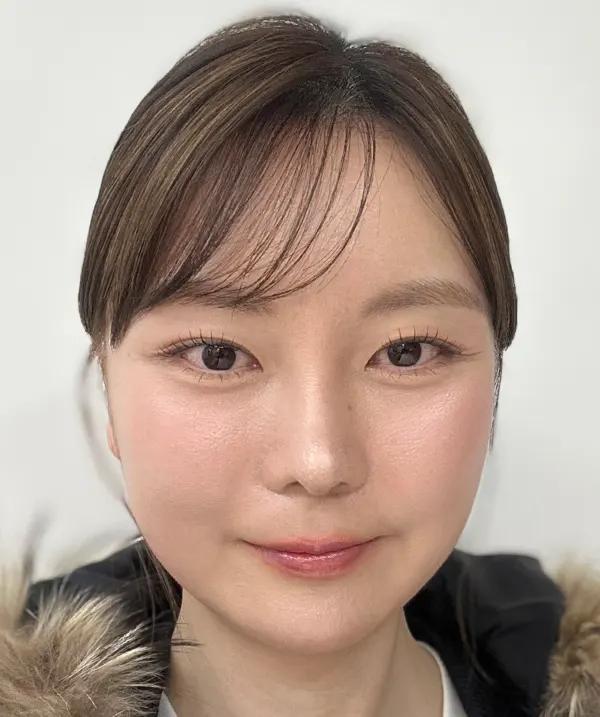 Before and after surgery front view