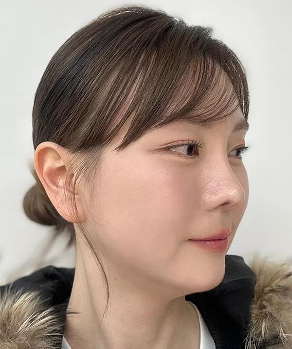 Before and after surgery side view