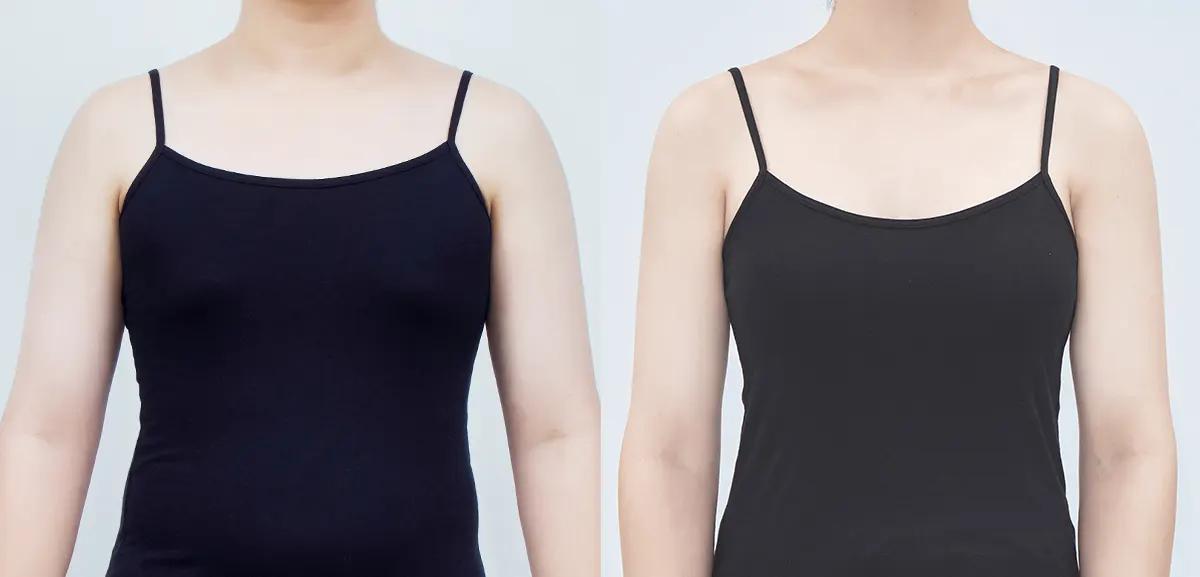 Before and after surgery