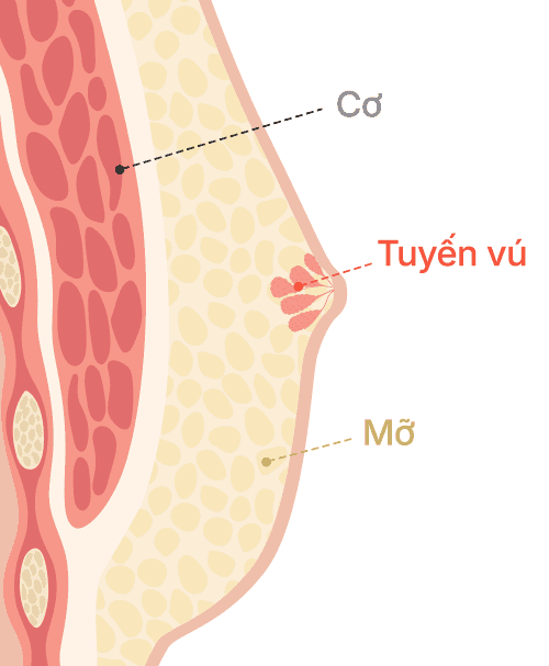 Gynecomastia surgery