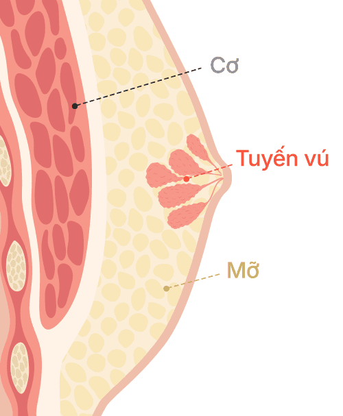 Gynecomastia surgery
