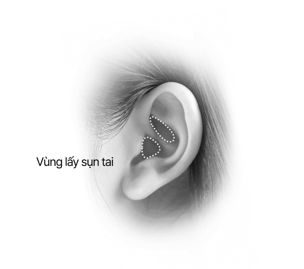 Lấy sụn tai