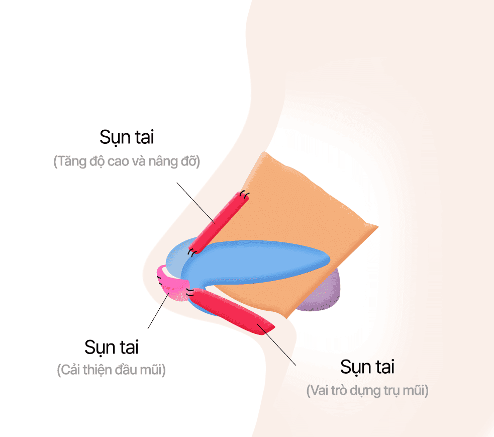 Chỉnh mũi bằng sụn tai
