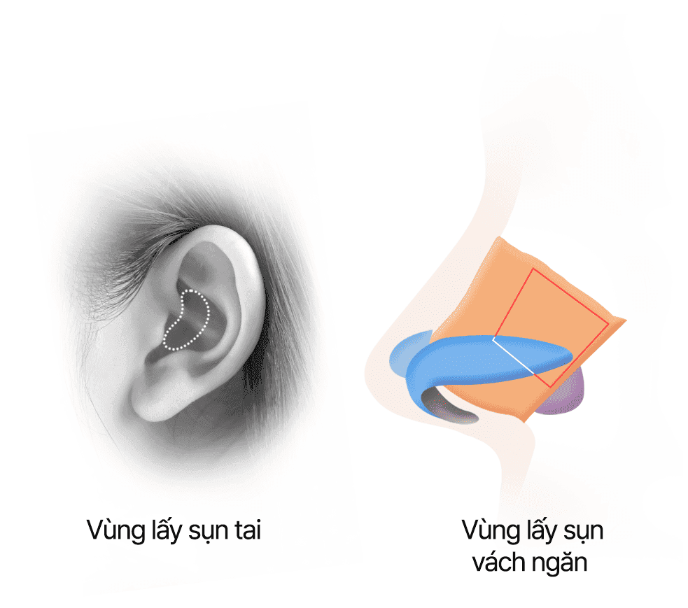 Lấy sụn tai và sụn vách ngăn