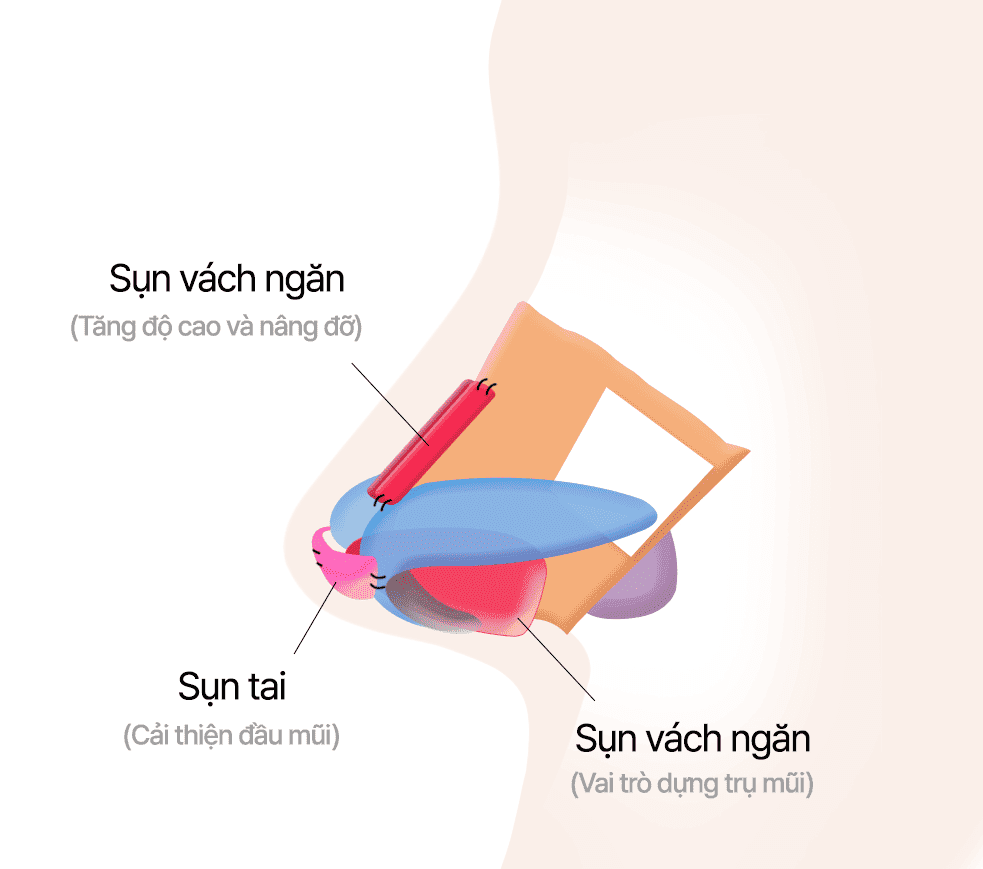 Sử dụng sụn tai và sụn vách ngăn để điều chỉnh