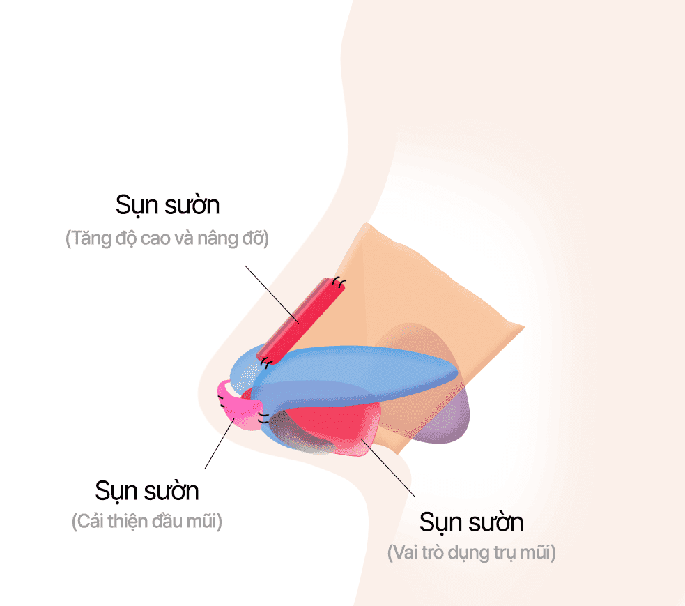 Điều chỉnh bằng sụn sườn