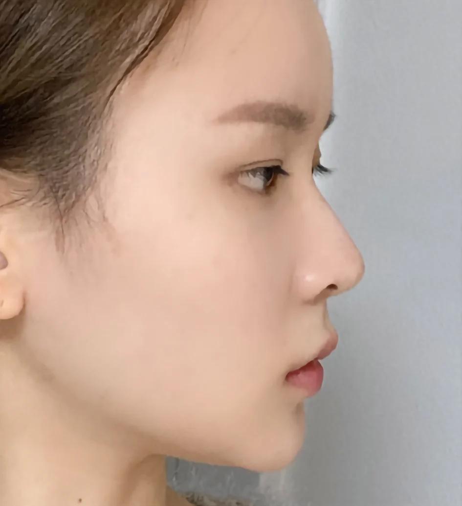 NaturGlow nose tip before