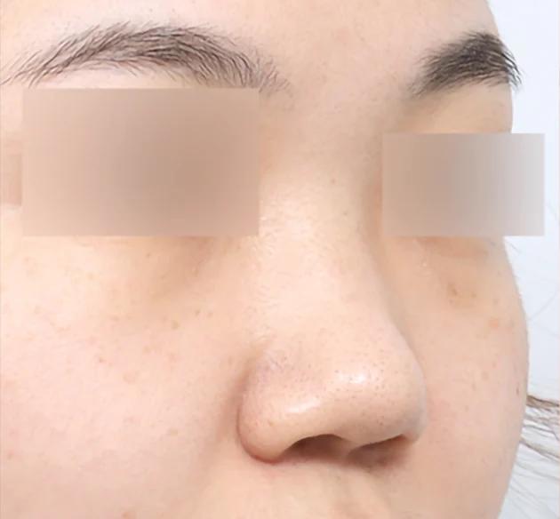 Sống mũi tự nhiên before