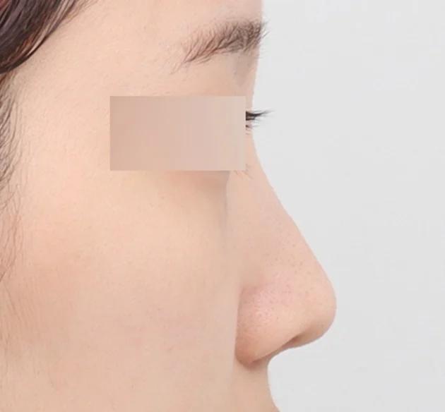 Đường trụ mũi đẹp tự nhiên và tinh tế,
được thiết kế phù hợp theo từng cá nhân before