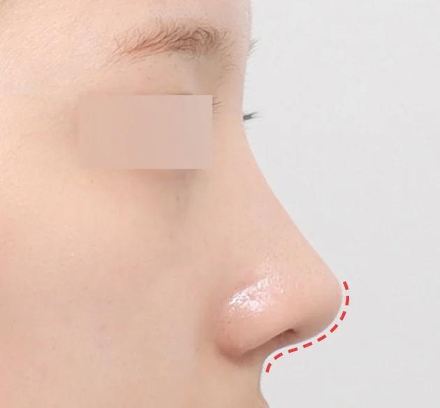Đường trụ mũi đẹp tự nhiên và tinh tế,
được thiết kế phù hợp theo từng cá nhân after