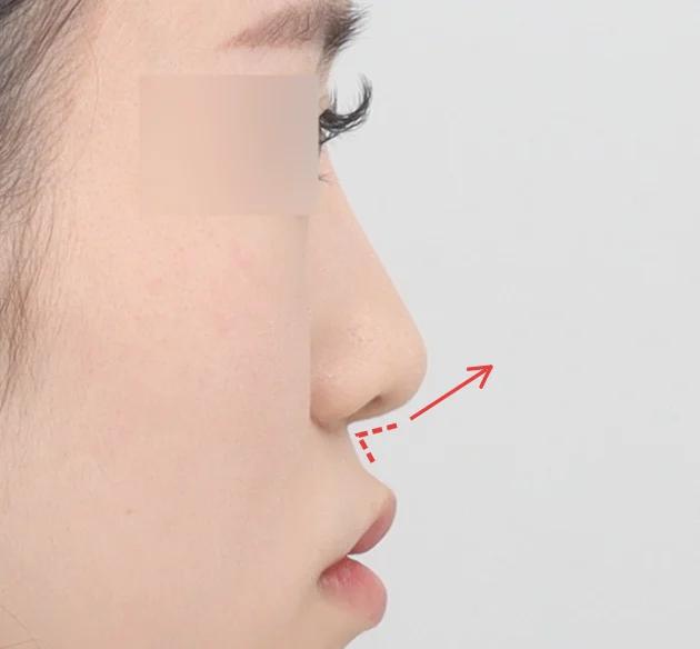 Góc chân mũi và môi được chỉnh tinh tế, 
giúp tổng thể dáng mũi cân đối và cuốn hút hơn before
