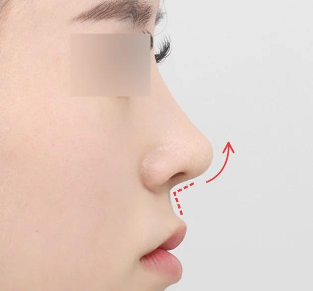 Góc chân mũi và môi được chỉnh tinh tế, 
giúp tổng thể dáng mũi cân đối và cuốn hút hơn after