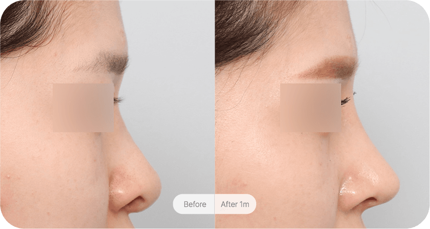 revision-rhinoplasty