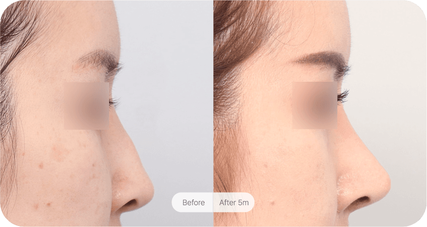 revision-rhinoplasty