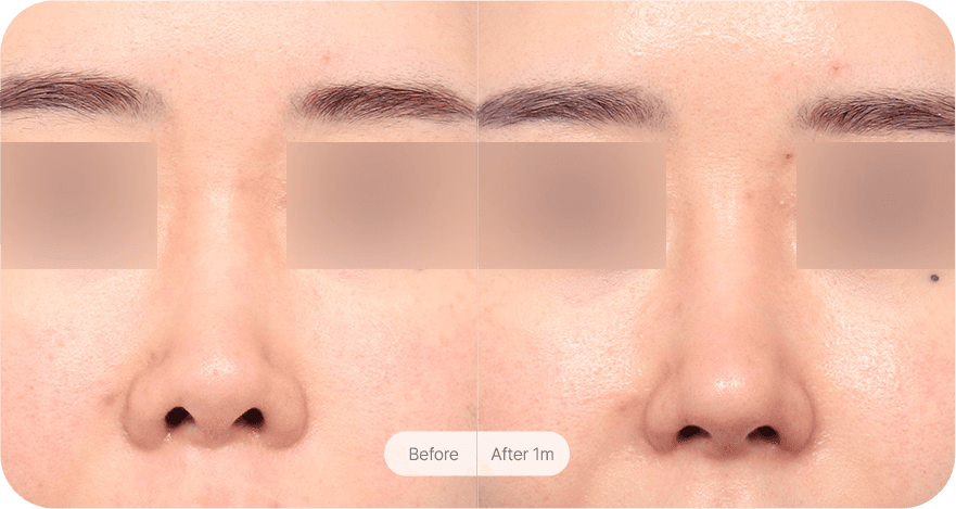 revision-rhinoplasty