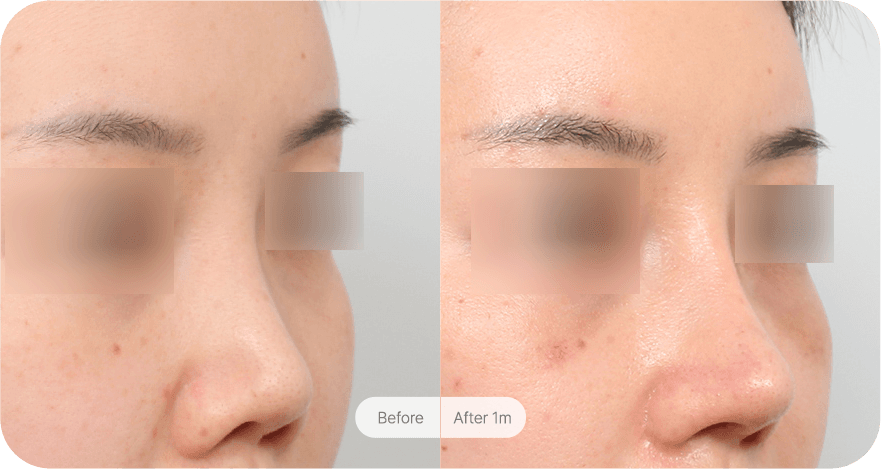 revision-rhinoplasty