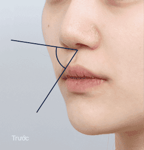 Mặt bên với chân mũi lõm và khoét lỗ