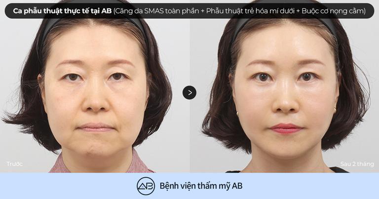 Phẫu thuật thẩm mỹ AB