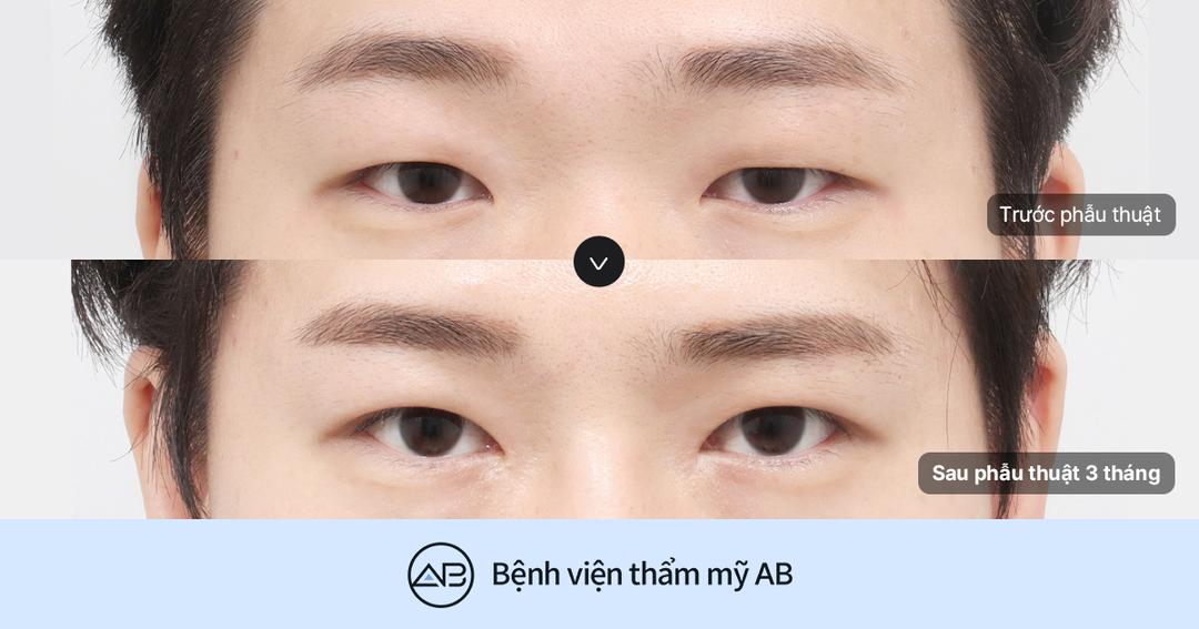 Mắt lệch (mắt không đều) ở nam giới có sửa được không? Khi nào cần chỉnh cơ nâng mi?